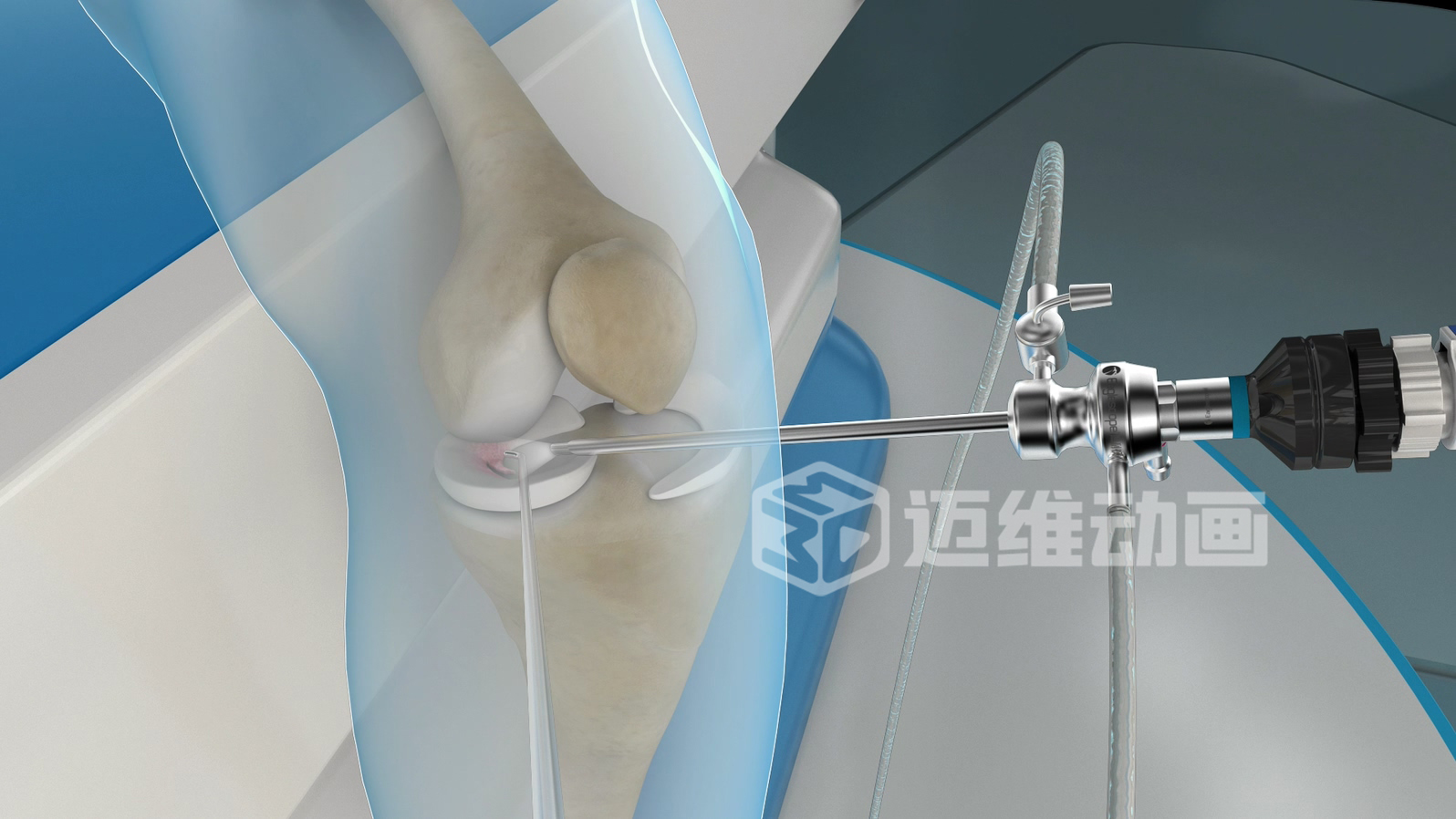 醫(yī)療器械三維動畫：打開精準(zhǔn)傳播與高效溝通的新大門(圖4)